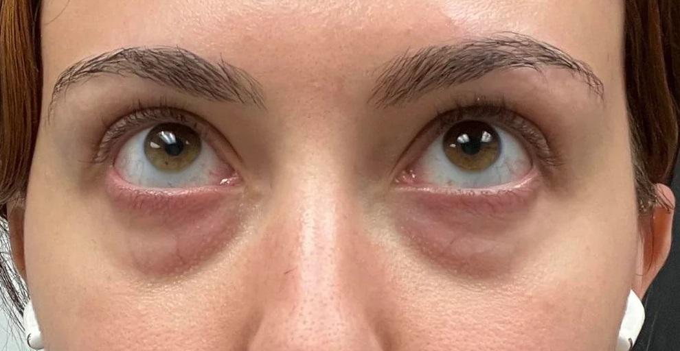 Adeus, Olheiras e Bolsas: Descubra as Melhores Soluções para um Olhar Mais Jovem e Descansado